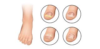 Image result for mykoza nehtů