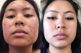 Curology's dermatology providers are real, live medical professionals—not bots, not ai. Treat Acne Fine Lines And More Curology Custom Skincare Start Your Free Trial