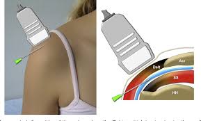 Image result for Subacromial Space Injection