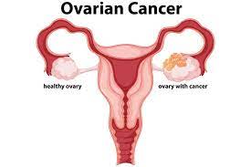 View real ovarian cancer pictures to know what does ovarian cancer look like and gain more knowledge about the disease. Ovarian Cancer Stages Causes Symptoms Treatment Parkway East Hospital