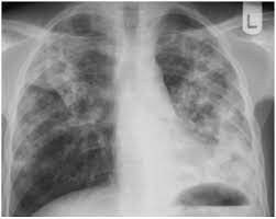 Residencia Pediatrica Leituras De Radiografias De Torax Em Criancas Suspeitas De Possuir Tuberculose Pulmonar