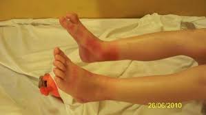 Allergy cure provides latest trends of allergy solutions for applying modern technologies and research applications in this domain. Boy 13 So Allergic To The Sun He Couldn T Sit Near A Window Is Cured By 20 Sun Cream And It Can Help Ease Eczema And Prickly Heat Too