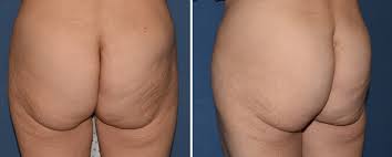 Makeup will help cover any remaining bruising. Plastic Surgery Case Study The Lower Buttock Lift For Buttock Ptosis Sagging Explore Plastic Surgery