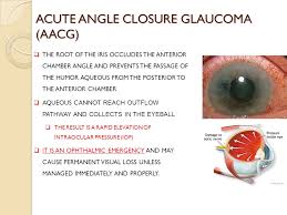 Acute glaucoma is an ophthalmologic. Acut Angle Closure Glaucoma Ppt Video Online Download
