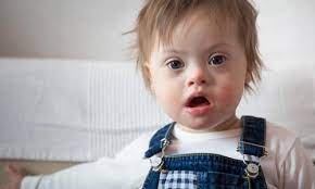 Why Doctors Should Ask About The Use Of Supplements In Patients With Down Syndrome Special Needs Resource