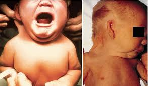 Image result for Webbed Neck