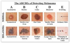 Scalp cancers can be quite serious, though: How To Check For Skin Cancer Skin Care Network