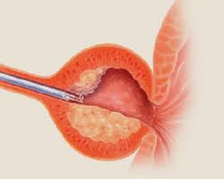 Huebner Urologie Prostata Inkontinenz Advance Argus Atoms Flowsecure Proact Remeex Laparoskopie