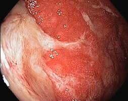 Image result for Proctitis