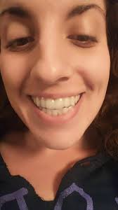 Had my attachments off today and a zoom whitening session to try and speed  up the whitening so I can get my bonding done before my wedding in 4 weeks!  August 2023-March