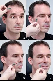 The exact cause is unknown. Facial Nerve Electrodiagnostics For Patients With Facial Palsy A Clinical Practice Guideline Springerlink