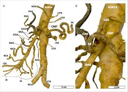 Akram jaffar, department of medical neuroscience dalhousie medicine new brunswick. Celiacomesenteric Trunk Cmt In The Body Of A 91 Year Old Female Download Scientific Diagram