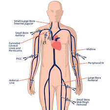 Image result for Peripheral IV Access