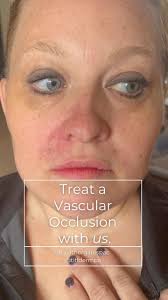 Well, the @fsdpa New Wave Dermatology Conference got a bit wild this year!  💉🌊, One of our models experienced a vascular occlusion and her injector  had already gone home. Naturally, @heathergatespac ...