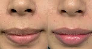 Bibir Terlihat Gelap? Inilah Penyebab dan Cara Mengatasi Bibir yang Terlihat Gelap Agar Tetap Mempesona - Kabar Besuki