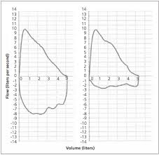 Image result for Vocal Cord Dysfunction