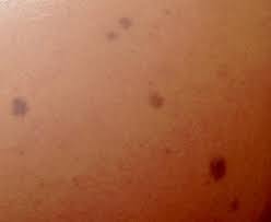 Pourquoi aller voir un dermatologue ? Grain De Beaute Wikipedia