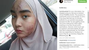 7 produk lokal perawatan kecantikan untuk kulit berjerawat di bawah 50 ribu. Gara Gara Memakai Produk Skin Care Wajah Mulus Gadis Malaysia Ini Jerawatan Tribunnews Com Mobile