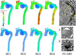 A backflow tester can be a person who inspects and/or tests backflow equipment, or a backflow tester can be the actual equipment used to monitor water flow and backflow prevention. Patient Specific Cfd Modelling In The Thoracic Aorta With Pc Mri Based Boundary Conditions A Least Square Three Element Windkessel Approach Romarowski 2018 International Journal For Numerical Methods In Biomedical Engineering Wiley Online