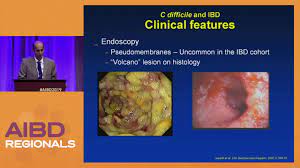 Clostridioides difficile (formerly clostridium difficile) colitis results from a disturbance of the normal bacterial flora of the colon, colonization by c difficile, and the release of toxins that cause mucosal. Prevention And Management Of C Difficile Colitis Youtube