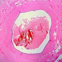 L'endometriosi è una patologia che coinvolge globalmente la salute della donna con effetti psicofisici spesso debilitanti. Endometriosi Wikipedia