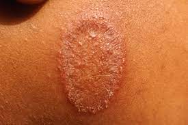 Use it twice a day, and the infection should start clearing within a few days, dr. Ringworm Nhs