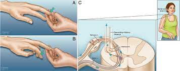 Le signe de tromner est similaire au signe de hoffman, mais le doigt est dévié vers le haut. Clinical Correlations Of Cervical Myelopathy And The Hoffmann Sign In Journal Of Neurosurgery Spine Volume 9 Issue 3 2008