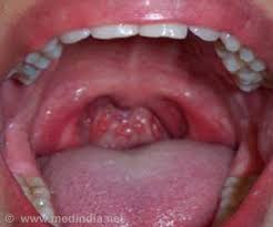 The cells in this area are mostly made up of squamous cells. Home Remedies For Sore Throat Chronic Sore Throat Sore Throat Remedies Throat Cancer