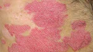 While the exact cause of psoriasis is unknown, genetics and the immune system are thought to be primary co. Psoriasis Vs Skin Cancer Pictures Knowing The Signs And More