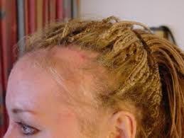 Sudden changes in your eyesight (e.g. Is Shorter Hair Better For Thinning Hair Quora