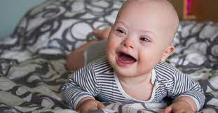 Down syndrome is also known as trisomy 21, because the person has three copies of chromosome 21 instead of two. Down Syndrom Trisomie 21 Baby At