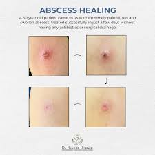 Image result for Skin Abscess