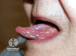 Image result for lichen planus on tongue)