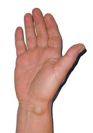 Ganglion Uberbein Dusseldorf Yuveo Klinik