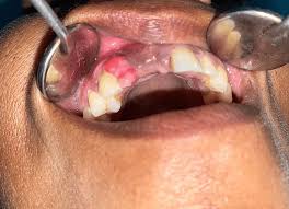 Image result for granuloma gum disease