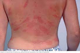 Chronic Hives Symptoms And Causes Mayo Clinic