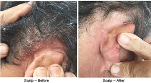 Learn how to tell if you have it and how you can reduce your risk. Psoriasis On The Scalp Before And After 4 Weeks Of Psorend Bec Download Scientific Diagram