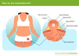 Wenn die geschwächte stelle oder das loch groß genug wird, kann ein stück des inneren organs aus dieser stelle herausragen. Leistenbruch Ursachen Symptome Diagnose Behandlung