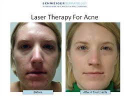 The Difference Between Isolaz Therapy And Blue Light Therapy For Acne