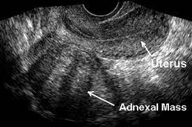 Transvaginal Ultrasound Antero Posterior View Of The Uterus With A Thin Download Scientific Diagram