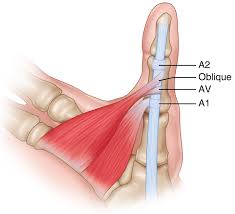 12519 regency pkwy, huntley, il 60142 phone 815.455.0800, fax 847.669.3772 11‐2016 flexor pollicus longus repair rehabilitation protocol kelly holtkamp, m.d. Flexor Tendon Springerlink Trigger Thumb Hand Surgery Pediatric Patients
