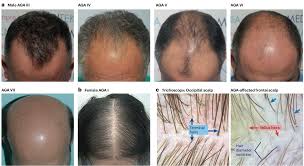 Image result for Alopecia