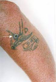 If your skin procedure was above your neck, sleep with the head of your bed raised 45 degrees for the first ____ days after your procedure. Artwork To Be Studied