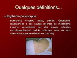 We did not find results for: Ppt Les Maladies Eruptives De L Enfant Powerpoint Presentation Free Download Id 230344