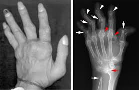 Image result for XRay Changes in Rheumatic Conditions