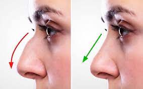 Buonassisi explains some surprising facts about open rhinoplasty. Rhinoplasty Before And After Photos Are Helpful Find Out Why