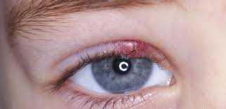 Black tea bag for stye. If You Wake Up And Your Eye Looks Like This Here Are 11 Remedies You Should Know Mmmbuzz