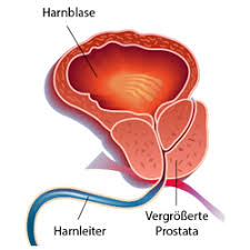 Explains prostate problems including prostatitis and benign prostatic hyperplasia. Hintergrundwissen Prostata Radiologie De