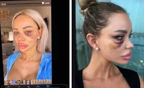 Dedicated to the lovely romanian tv host and model bianca dragusanu. Bianca DrÄƒgusanu BÄƒtutÄƒ De Mai MulÅ£i Fosti IubiÅ£i Unul Dintre Ei A Lovit O PanÄƒ Nu S A Mai Miscat A Ajuns La Spital In ComÄƒ