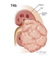 The most common symptoms tend to show up in the lower back area, or are evident in urine. Kidney Cancer Symptoms Diagnosis Treatment Urology Care Foundation